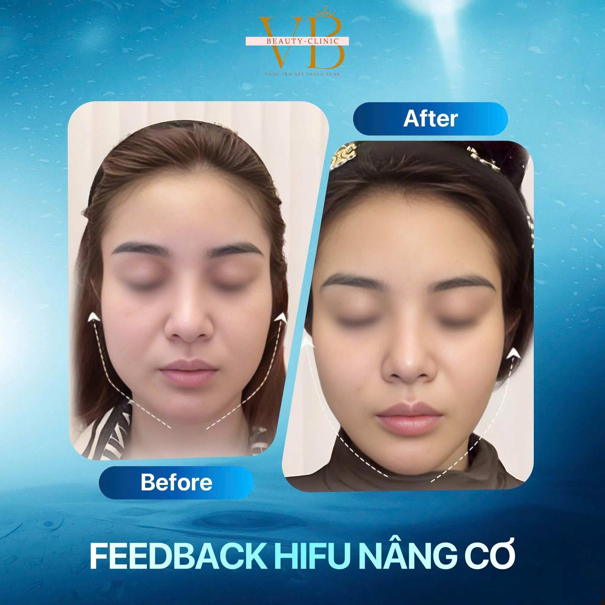 Máy triệt lông Công suất 100