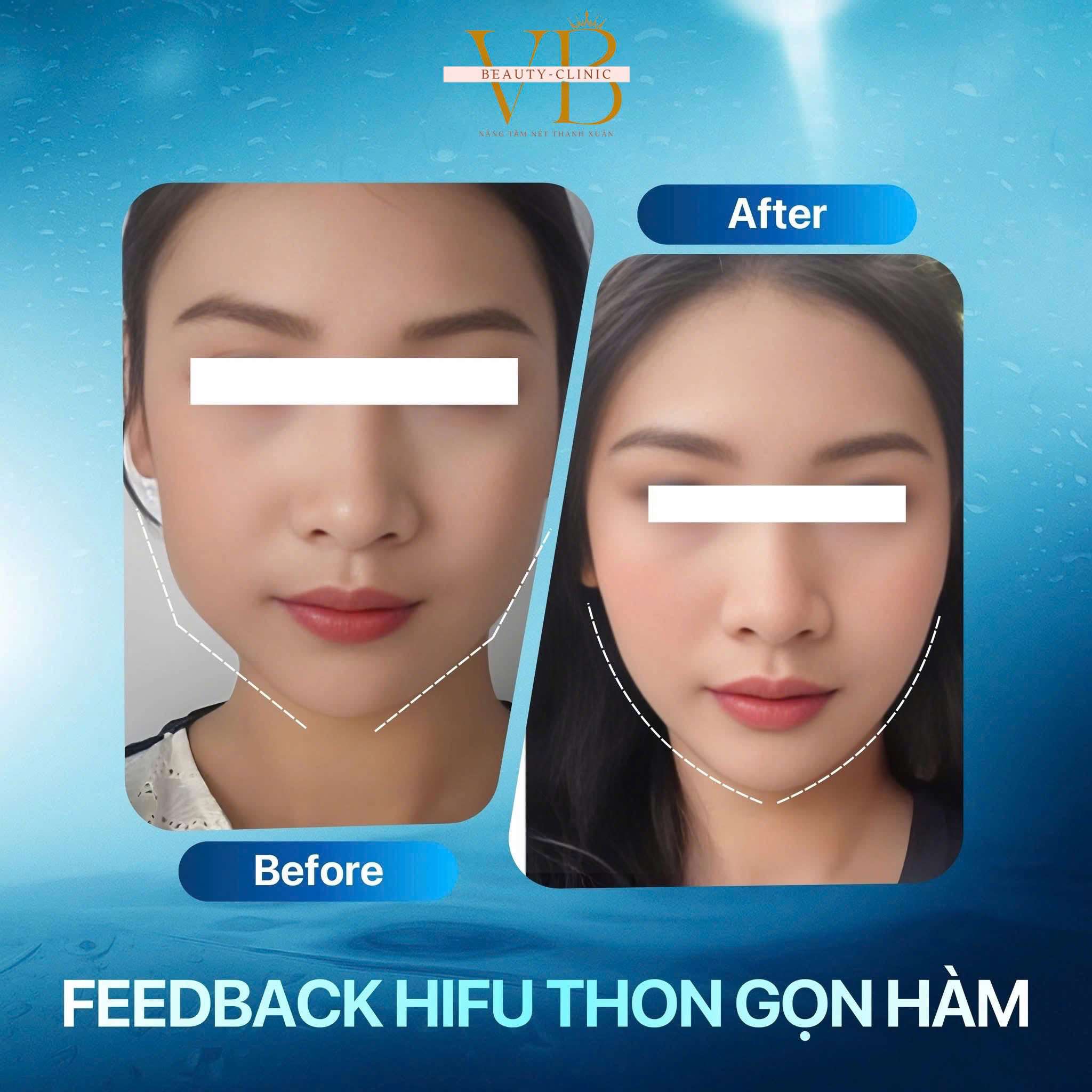 Máy triệt lông Công suất 100