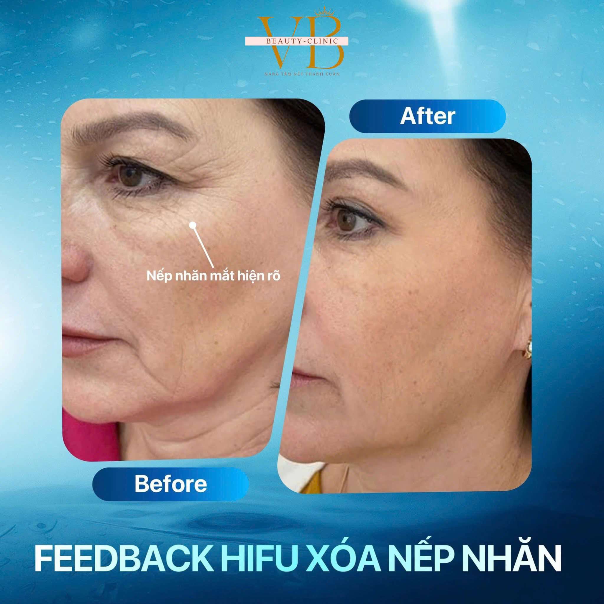 Máy triệt lông Công suất 100