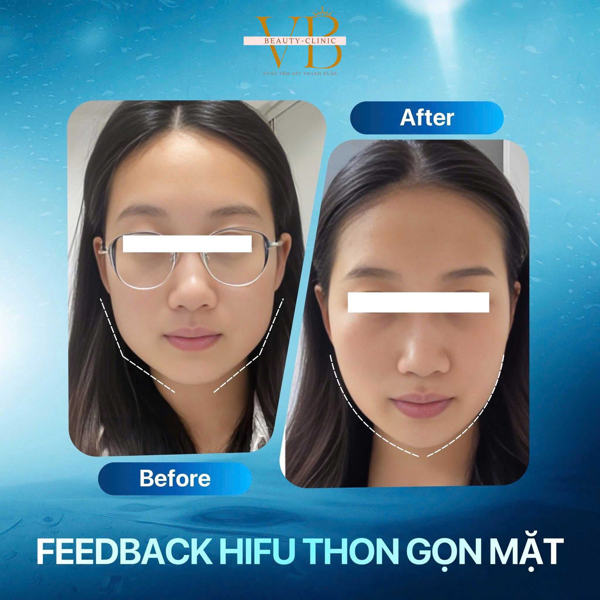 Máy triệt lông Công suất 100