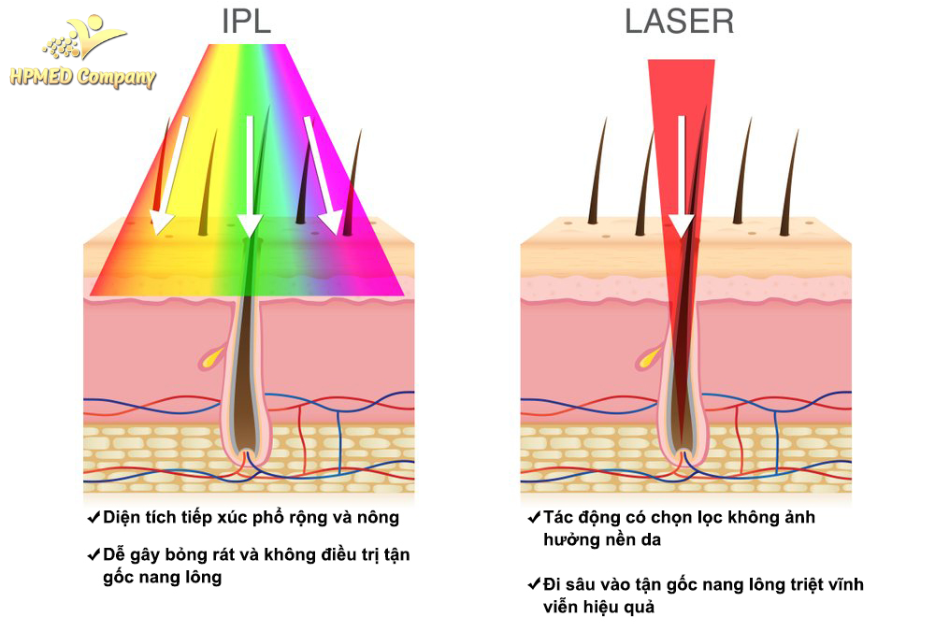 So sánh Công nghệ IPL và Diode Laser