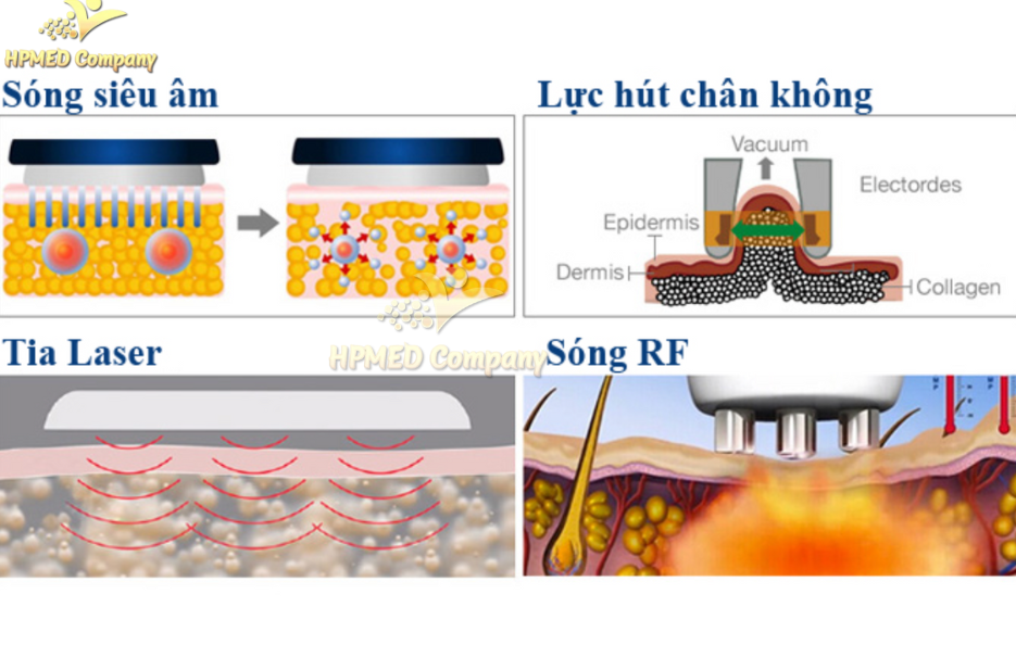 Các công nghệ phổ biến trong máy giảm béo bụng