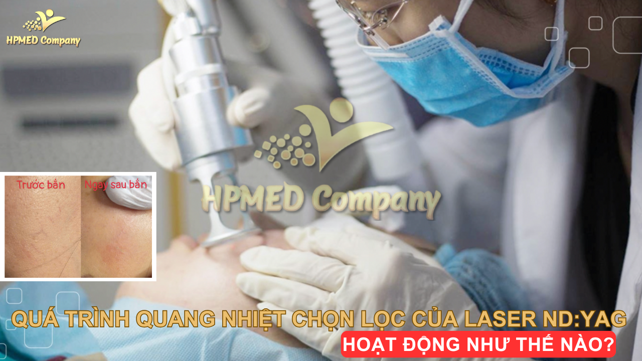 Quá trình quang nhiệt chọn lọc của laser ND:YAG 