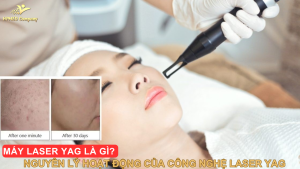 Máy Laser YAG Là Gì? Nguyên Lý Hoạt Động Của Công Nghệ Laser YAG 2025