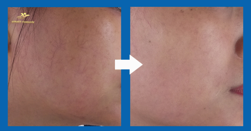 Điều Trị Giãn Mao Mạch Bằng Laser 980nm Có Hiệu Quả Không? 2 May triet long tai nha 5 9