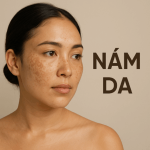 Nám Da: Nguyên Nhân, Dấu Hiệu và Cách Điều Trị Hiệu Quả