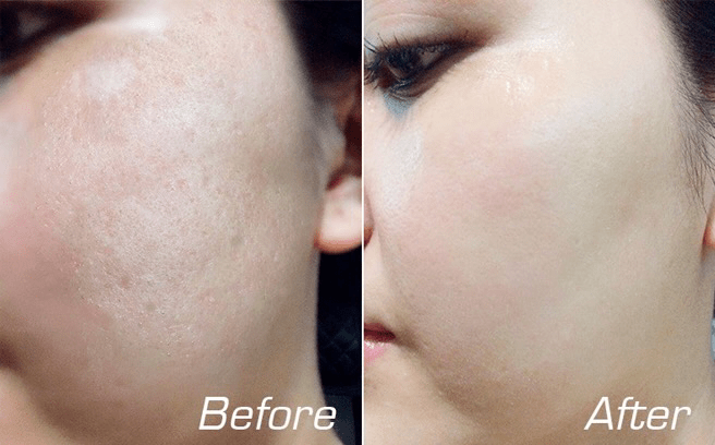 điều trị sẹo bằng máy rf vi điểm