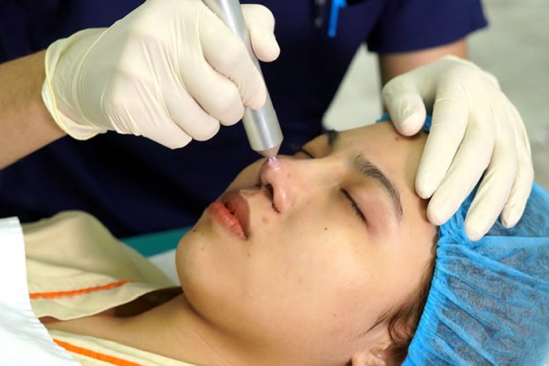 may plasma lanh tri mun giai phap hieu qua cho lan da sach mun 66e50675921fe