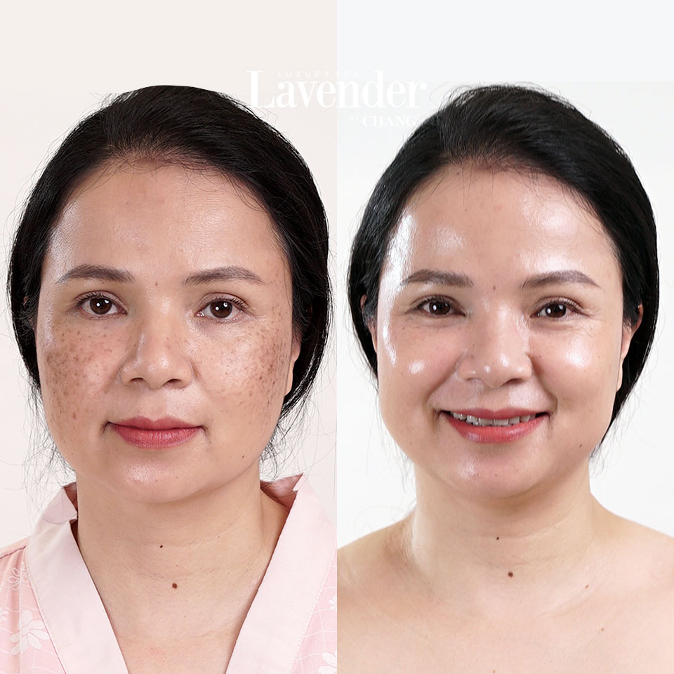 Spa trị nám ? Top 5 Lợi ích khi trị nám tại spa