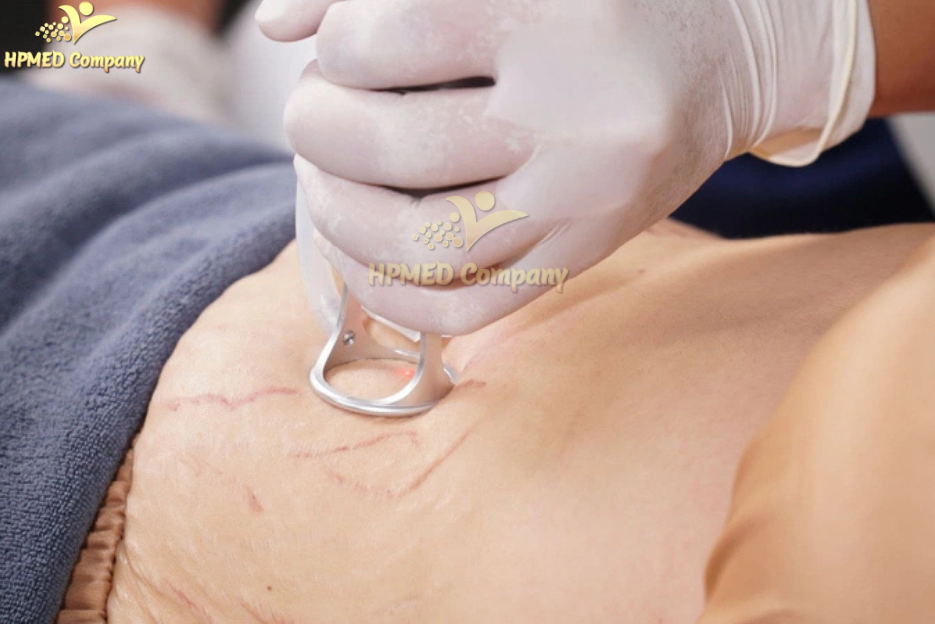 Trị rạn da bằng máy laser co2 fractional Trị rạn da bằng máy laser co2 fractional