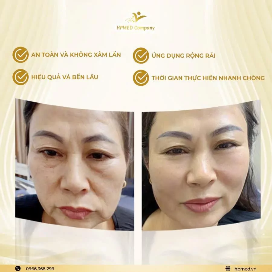 Máy Hifu Nâng Cơ Cao Cấp HPmed