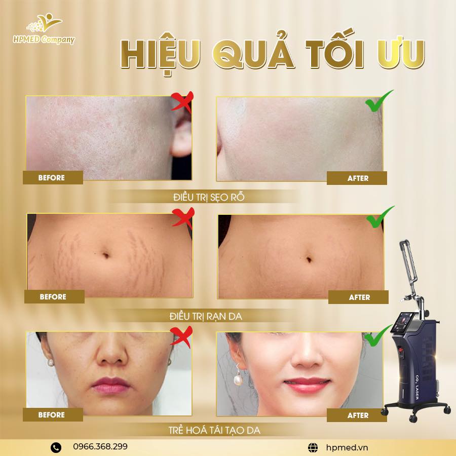 Công dụng Máy Laser Co2 Fractional Harmoni RF