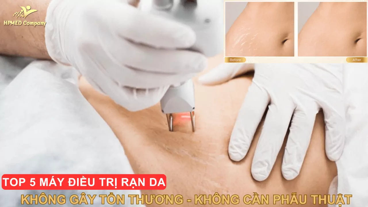 Top 5 Máy Trị Rạn Da Được Ưa Chuộng Top 5 Máy Trị Rạn Da Được Ưa Chuộng