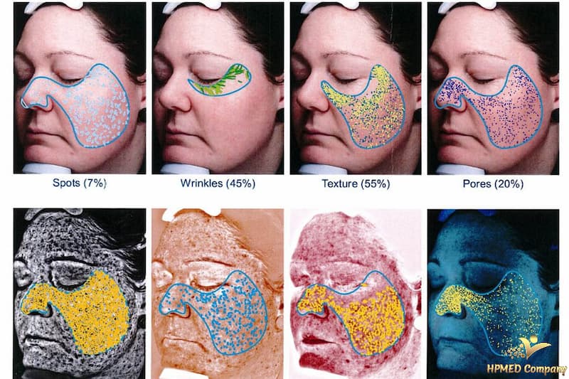 Một số hình ảnh chụp và phân tích bằng máy phân tích da cao cấp