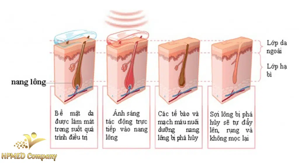 &nbsp;cơ chế hoạt động của máy triệt lông ipl
