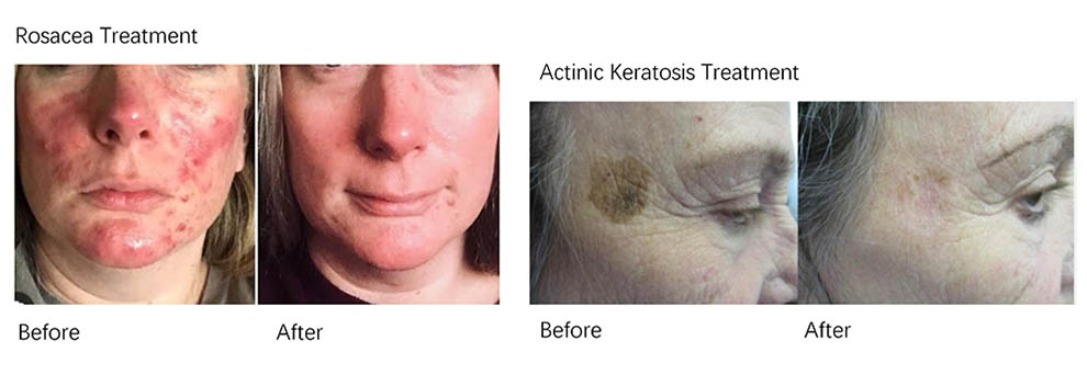 Máy vòm ánh sánh sinh học Medilux PDT LED 8 Máy Vòm Ánh Sáng Sinh Học Medilux PDT LED - 08