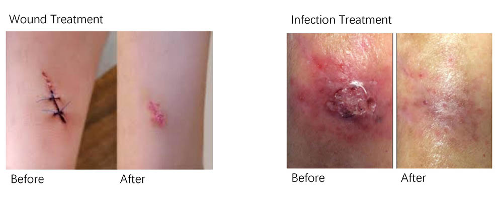 Máy vòm ánh sánh sinh học Medilux PDT LED 9 Máy Vòm Ánh Sáng Sinh Học Medilux PDT LED - 09