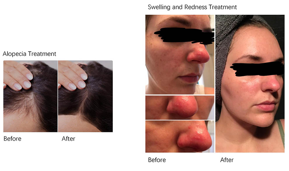 Máy vòm ánh sánh sinh học Medilux PDT LED 10 Máy Vòm Ánh Sáng Sinh Học Medilux PDT LED - 10