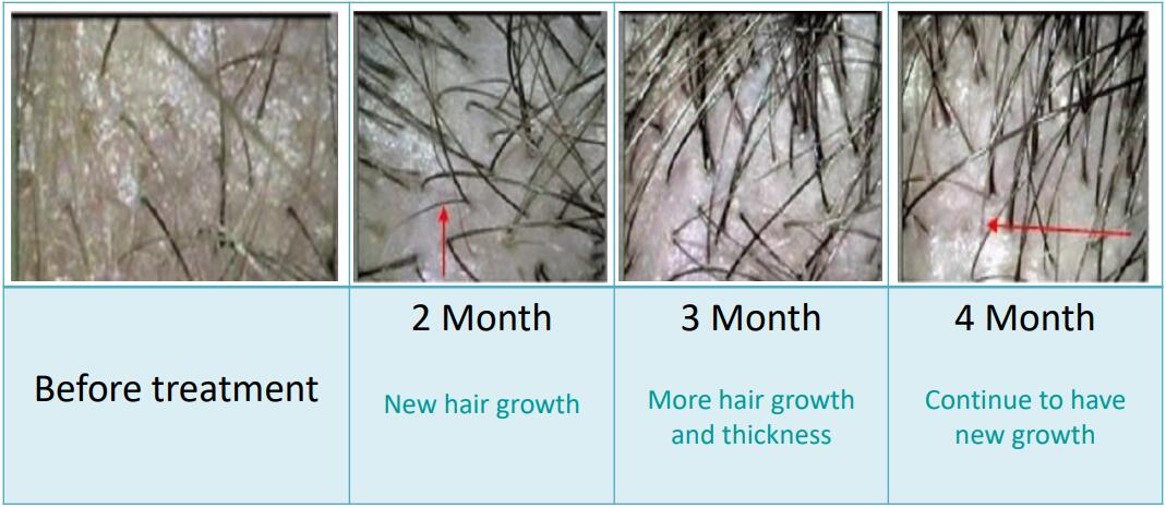 Máy Mọc Tóc, Máy Kích Thích Mọc Tóc Bằng Laser SH650 Cao Cấp 10 máy mọc tóc, máy điều trị rụng tóc bằng laser