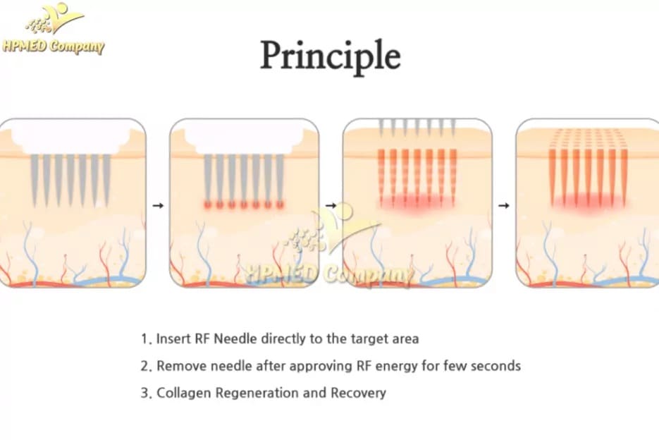 cơ chế hoạt động máy rf vi điểm