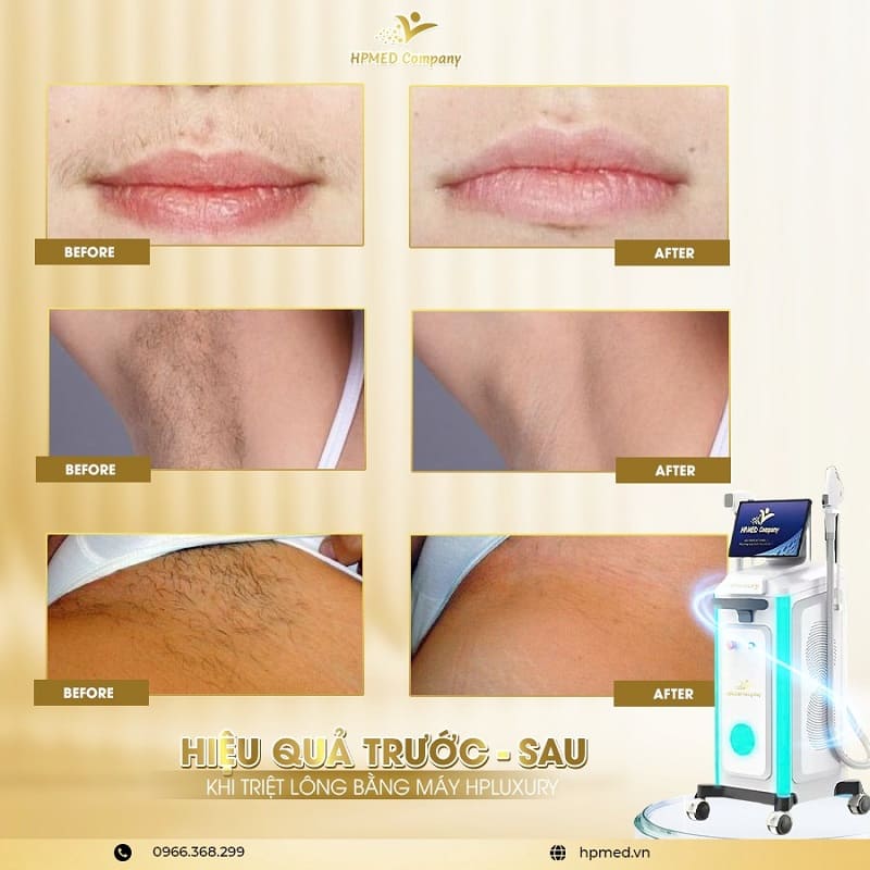 Máy Triệt Lông Diode Laser Cao Cấp