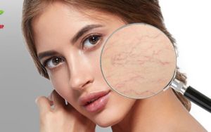 Sửa Máy Laser 980nm Điều Trị Giãn Mao Mạch Sanhe – Dịch Vụ Chuyên Nghiệp và Hiệu Quả Số 1 Việt Nam