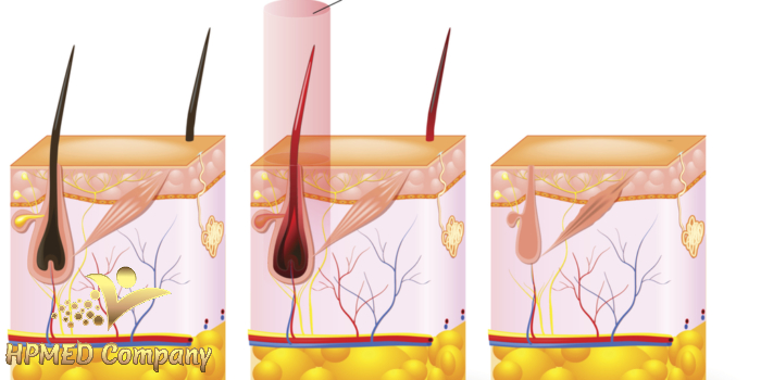 Công nghệ triệt lông IPL và OPT Điều gì khác biệt?