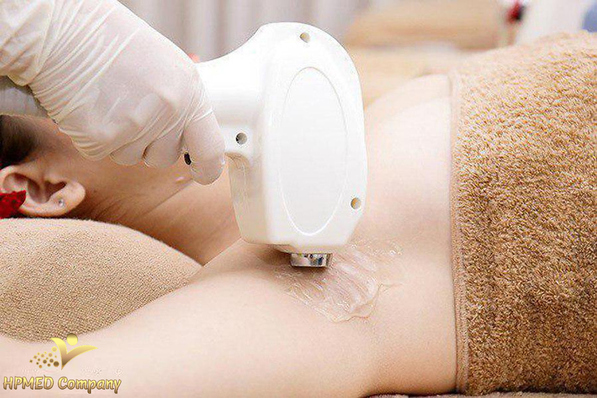 Triệt lông bằng máy diode laser