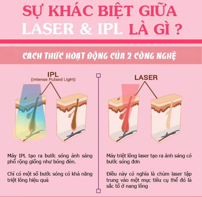 sự khác nhau giữa IPL và Diode Laser