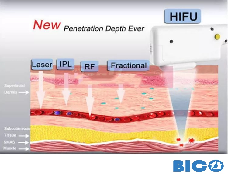 Các loại máy HIFU phổ biến