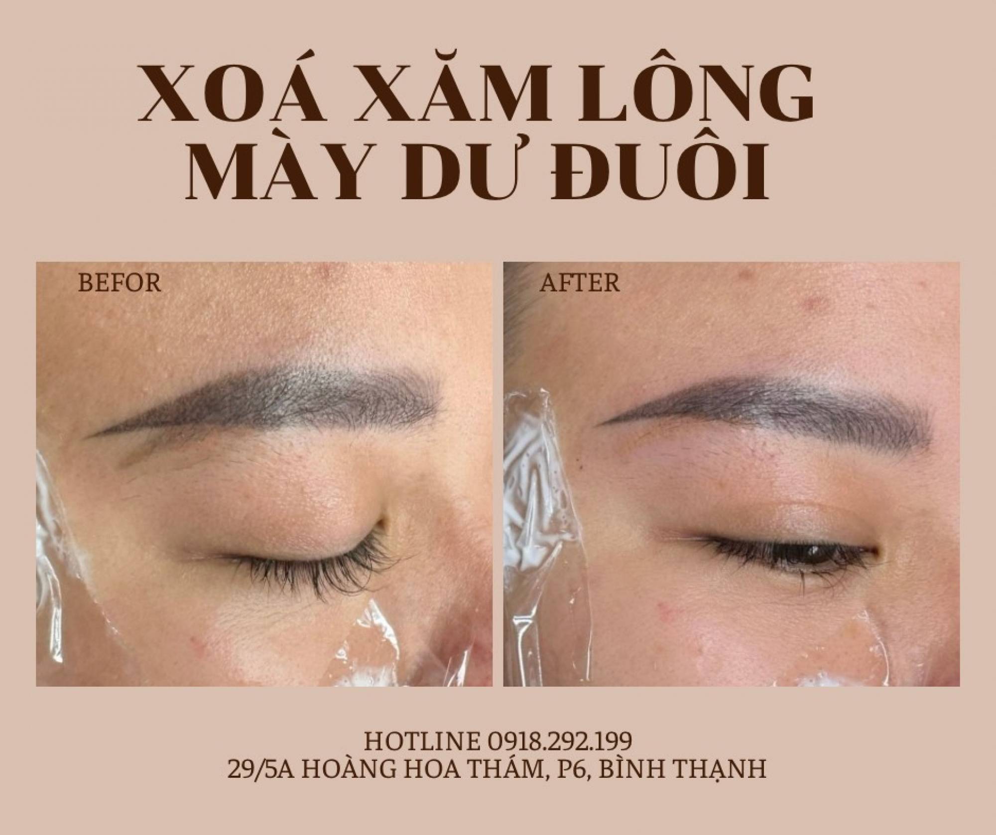 Công Nghệ Xóa Xăm Lông Mày Hiệu Quả Nhất Hiện Nay