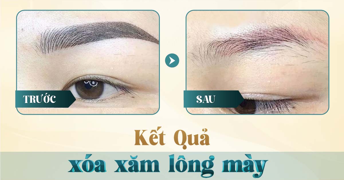 Hình ảnh sau khi xóa xăm bằng laser