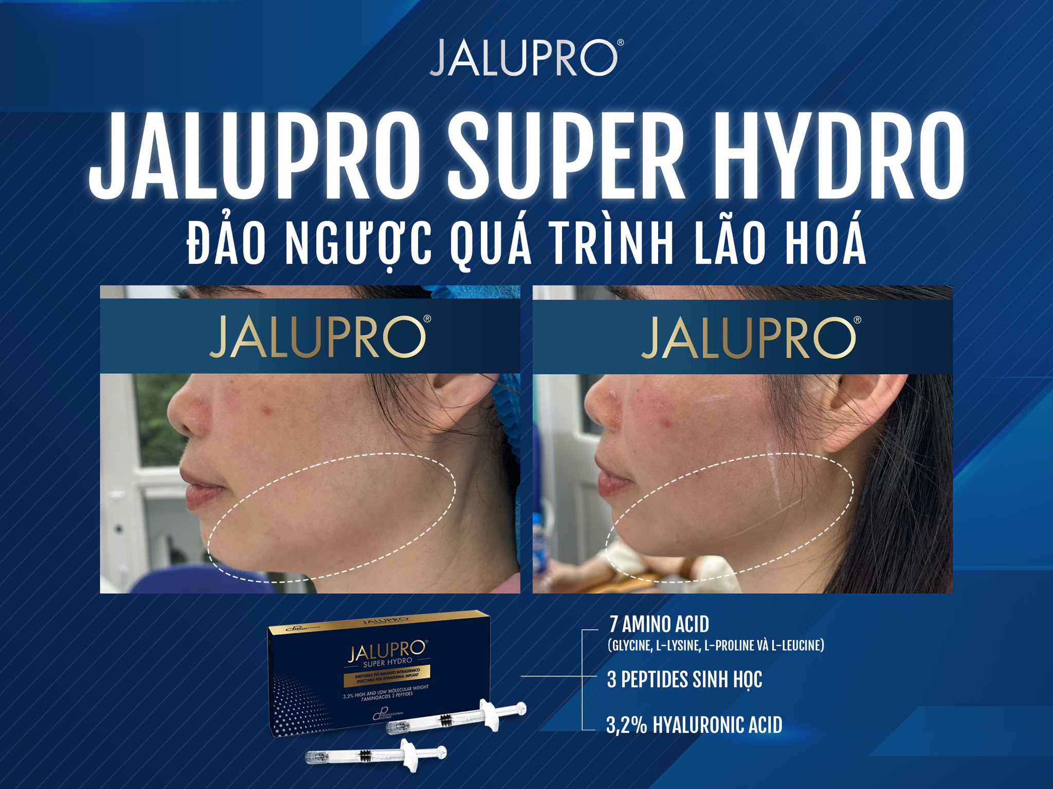 Jalupro: Giải pháp trẻ hóa da hiệu quả