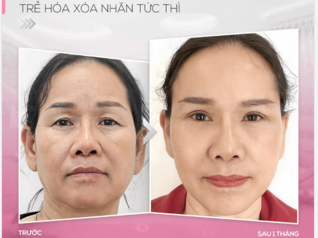 Máy HIFU là gì? Khám phá công nghệ làm đẹp tiên tiến