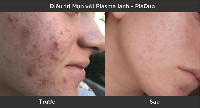 Máy Plasma Lạnh Trị Mụn: Giải Pháp Hiệu Quả Cho Làn Da Sạch Mụn