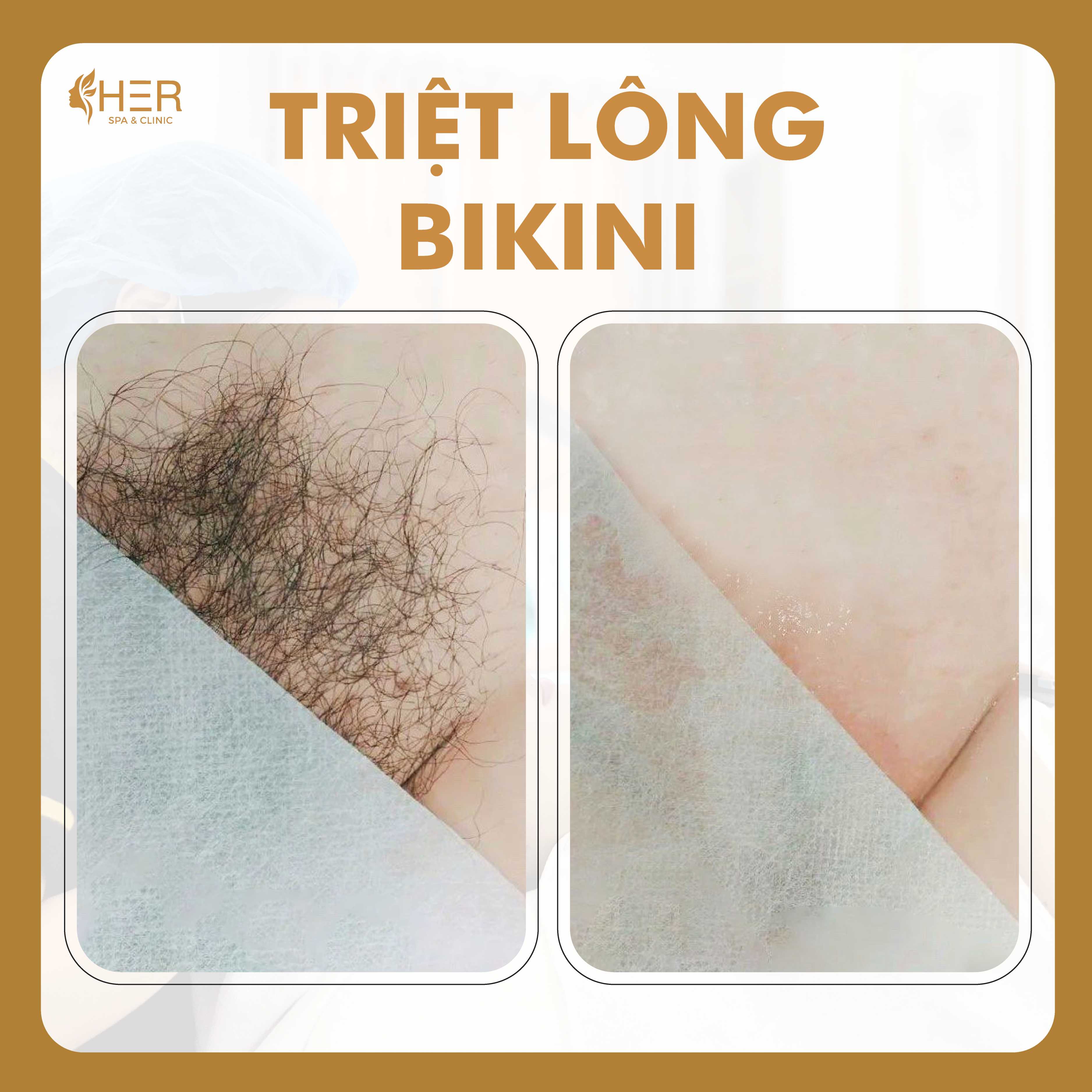 Máy Triệt Lông Bikini Tốt Nhất Hiện Nay