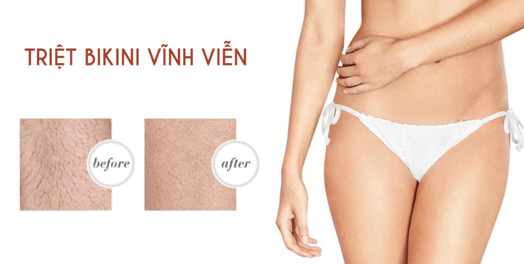 Máy Triệt Lông Bikini Tốt Nhất Hiện Nay