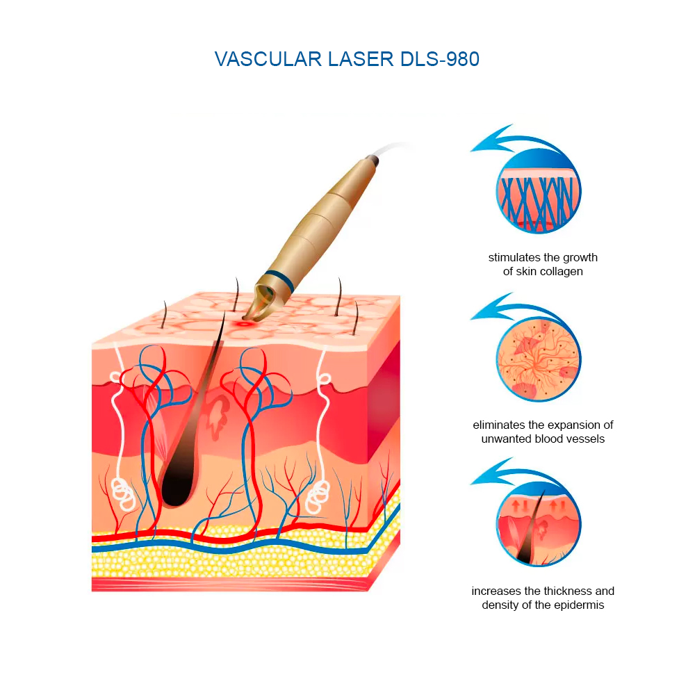 Sửa Máy Laser 980nm Điều Trị Giãn Mao Mạch Sanhe - Dịch Vụ Chuyên Nghiệp và Hiệu Quả