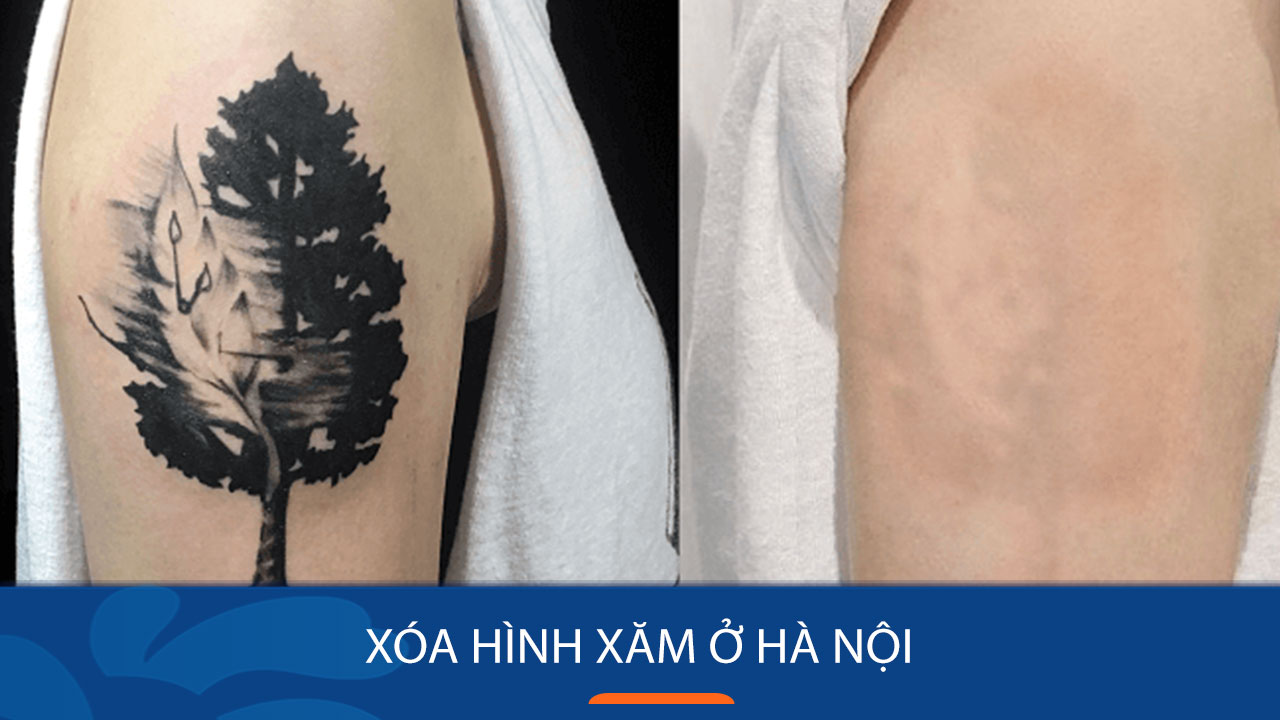 Top địa chỉ xóa xăm uy tín