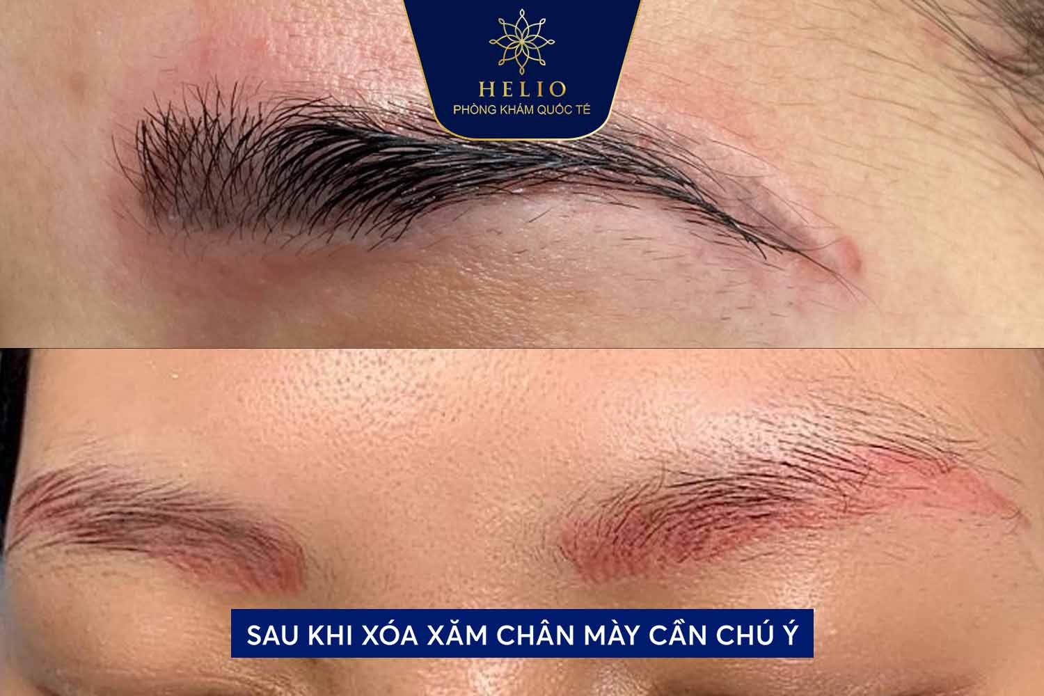 Xóa Xăm Chân Mày Bằng Laser: Công Nghệ Hiện Đại