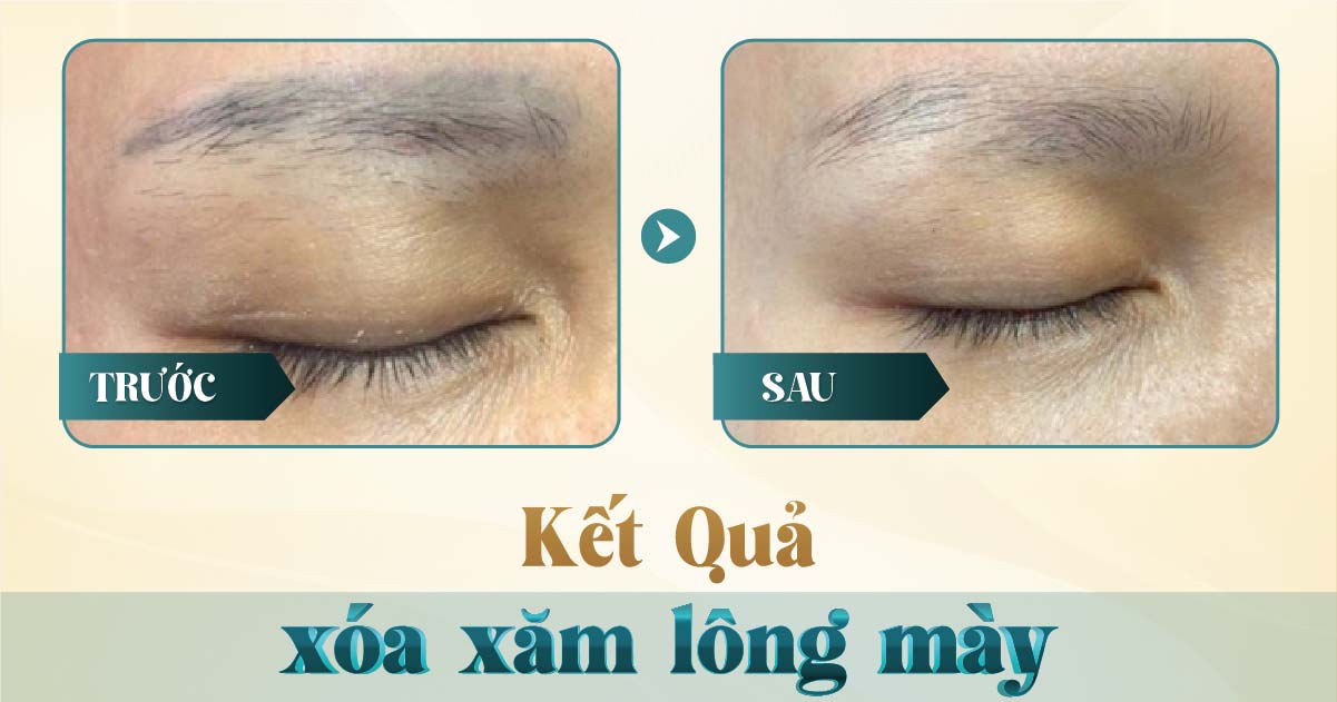 Xóa Xăm Chân Mày Bằng Laser: Công Nghệ Hiện Đại