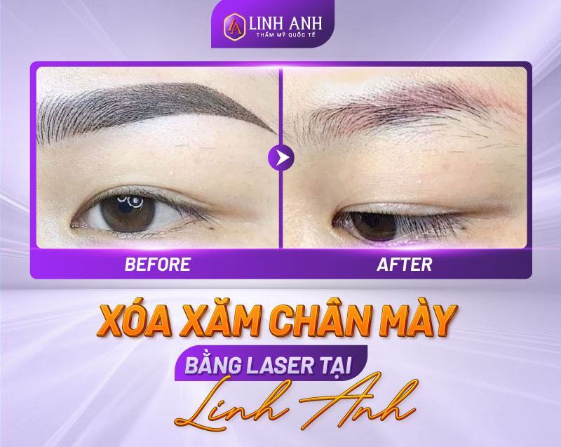 Xóa Xăm Chân Mày Bằng Laser: Công Nghệ Hiện Đại