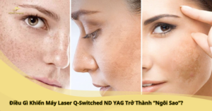 máy laser q-switched nd yag