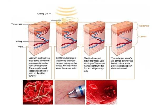 điều trị giãn mao mạch 980nm