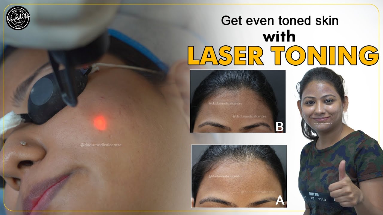 Giới thiệu về Laser Toning