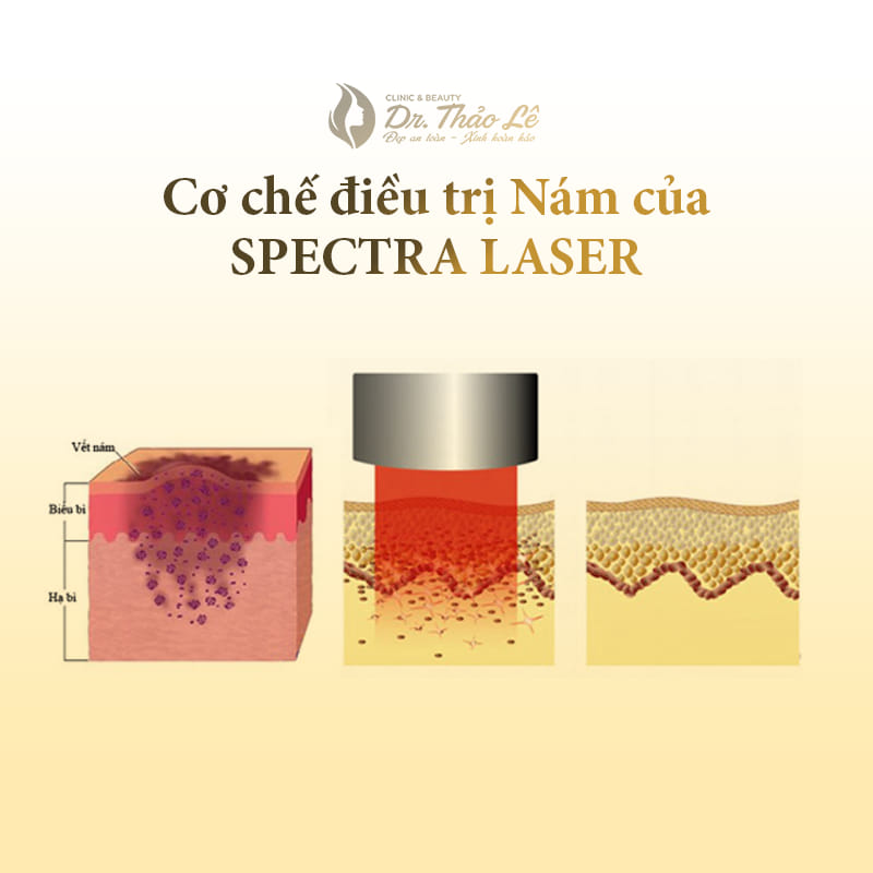 Laser trị nám là gì?