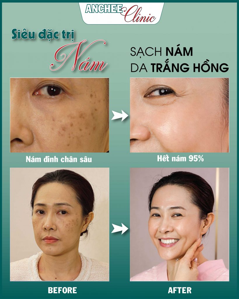 Các phương pháp điều trị nám tốt nhất