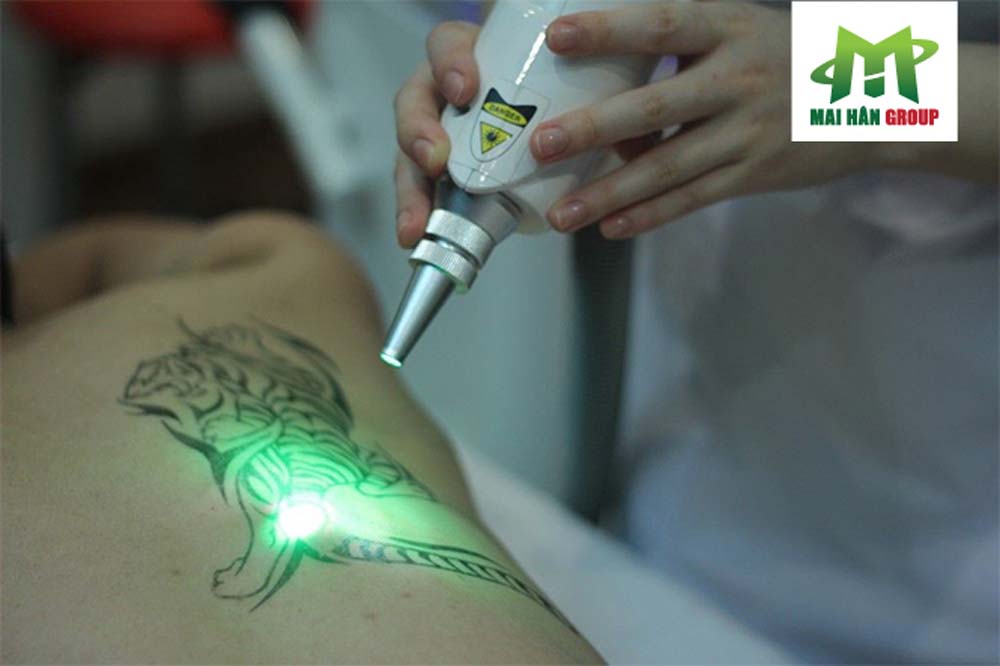 Công nghệ laser yag là gì