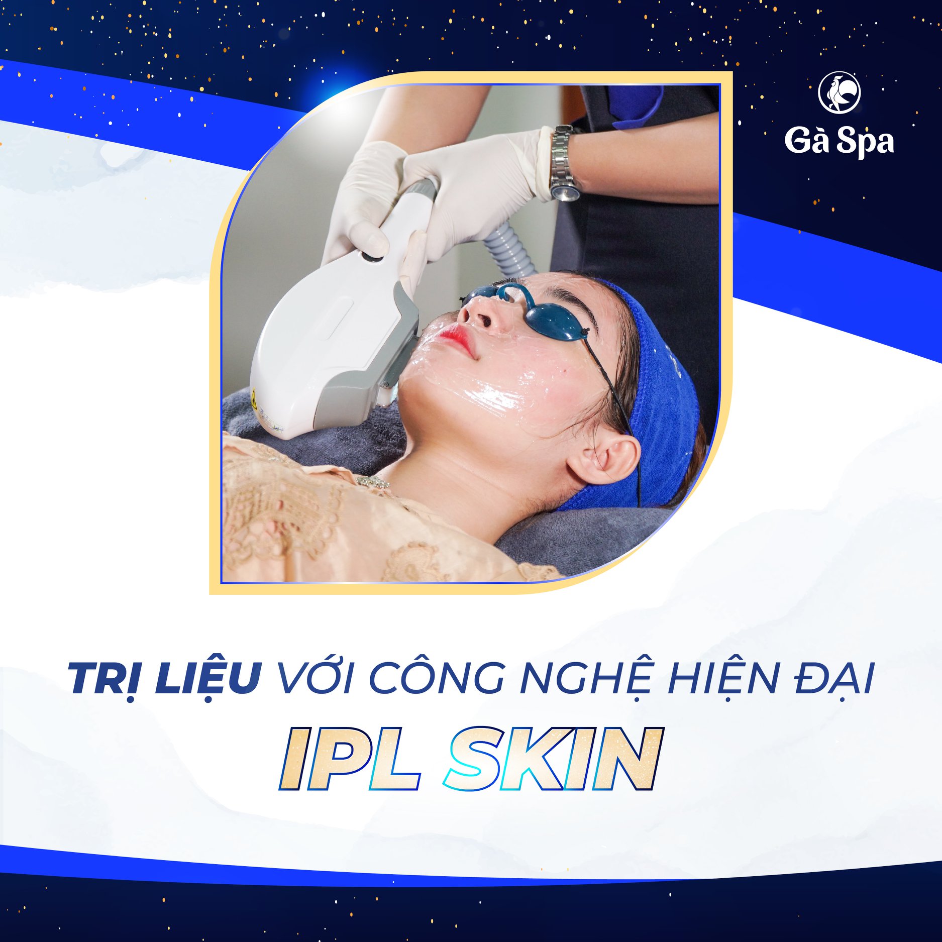 Điều trị nám bằng ipl