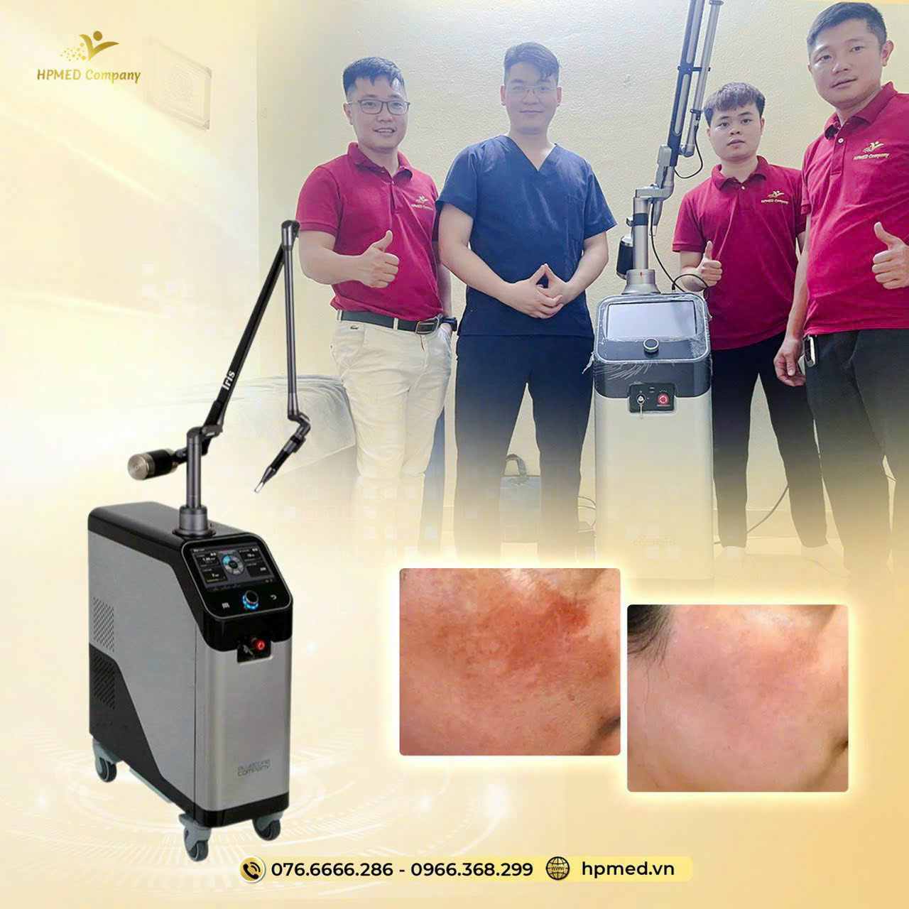 hpmed chuyen giao may laser iris cho bac sy viet 3